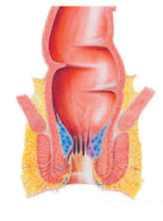 Grade 1 - Hemorrhoid protrudes into the anal canal but does not prolapse outside the anus.