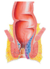 Grade 3 - Hemorrhoid protrudes through the anus dring straining or evacuation but needs to be manually returned to position.