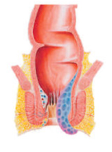 Grade 4 - Hemorrhoid remains prolapsed outside of the anus.
